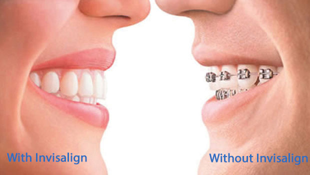 Yonkers Invisalign
