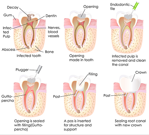 Root Canal in Yonkers